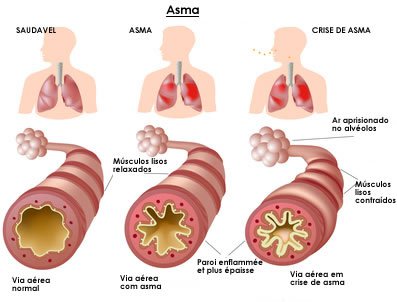 asma-resumo